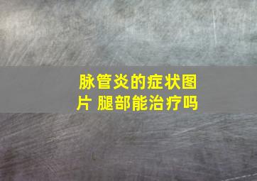 脉管炎的症状图片 腿部能治疗吗